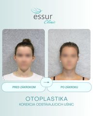 Otoplastika ESSUR Clinic