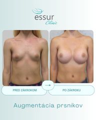 Augmentácia ESSUR Clinic