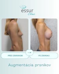 Augmentácia ESSUR Clinic
