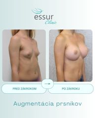 Augmentácia ESSUR Clinic