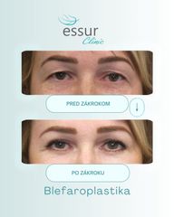 Blefaroplastika ESSUR Clinic