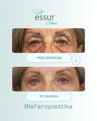 Blefaroplastika ESSUR Clinic