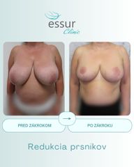 Mastopexia ESSUR Clinic