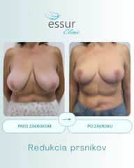 Mastopexia ESSUR Clinic