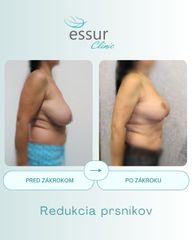 Mastopexia ESSUR Clinic