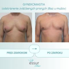 Gynekomastia ESSUR Clinic