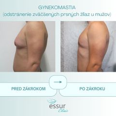 Gynekomastia ESSUR Clinic