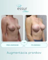 Augmentácia ESSUR Clinic