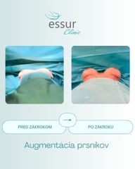 Augmentácia ESSUR Clinic