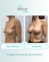 Augmentácia ESSUR Clinic