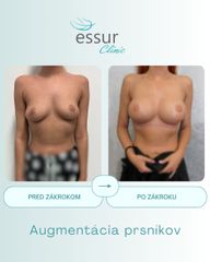 Augmentácia ESSUR Clinic
