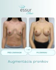 Augmentácia ESSUR Clinic
