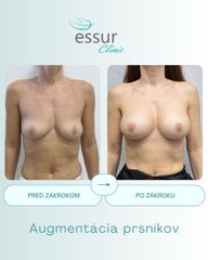 Augmentácia ESSUR Clinic