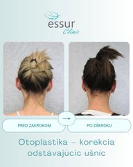 Otoplastika ESSUR Clinic