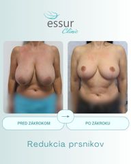 Mastopexia ESSUR Clinic