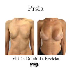 Zväčšenie pŕs - MUDr. Dominika Kevická