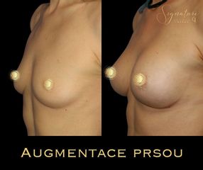paulis - augmentacia4