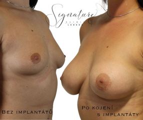 paulis - augmentacia5