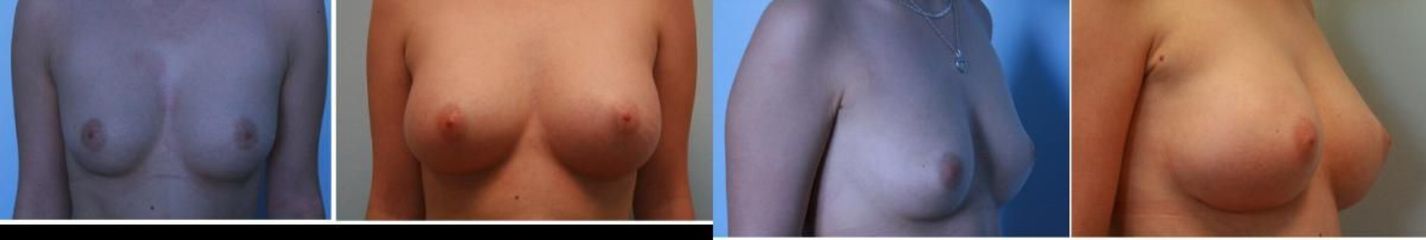 paulis - augmentacia3 (1)