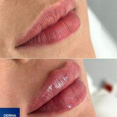 Kyselina hyalurónová - DERMACENTER