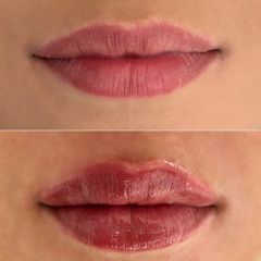 Kyselina hyalurónová - DERMACENTER