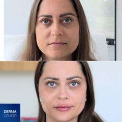 Kyselina hyalurónová - DERMACENTER