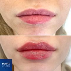 Kyselina hyalurónová - DERMACENTER