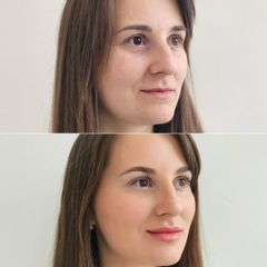 DERMACENTER - kyselina hyalurónová
