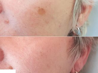 Chemický peeling pred a po - 879922
