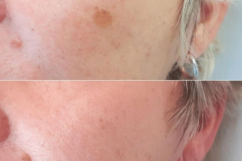 Chemický peeling pred a po - 879922