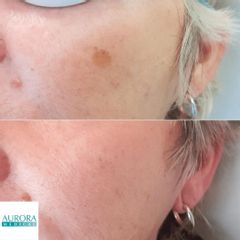 Peeling DERMACENTER
