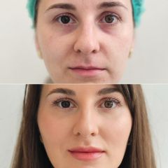 kyselina hyalurónová - DERMACENTER