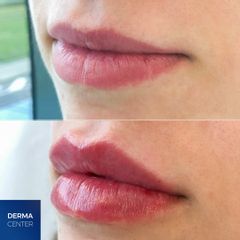 kyselina hyalurónová - DERMACENTER