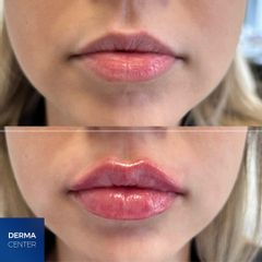 kyselina hyalurónová - DERMACENTER