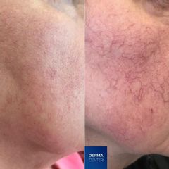 LASEROVE OSETRENIE ODSTRANUJUCE CIEVNE LÉZIE - LASER VASCULAR THERAPY - LASEROVE OSETRENIE ODSTRANUJ