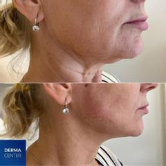 Neinvazívny lifting DERMACENTER