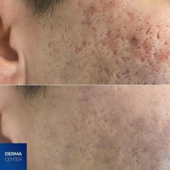 Frakčný laser DERMACENTER
