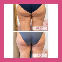 Alternatíva liposukcie - neinvazívne odstránenie tuku a celulitídy