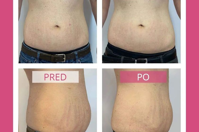 Neinvazívna liposukcia pred a po - 828331