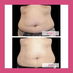 Neinvazivní liposukcia - Health & Beauty Clinic MUDr. Stela Muránska