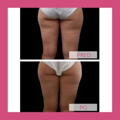 Neinvazivní liposukcia - Health & Beauty Clinic MUDr. Stela Muránska