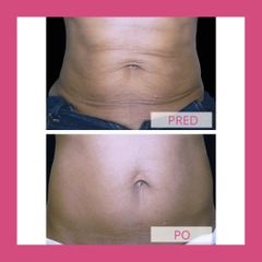 Neinvazivní liposukcia - Health & Beauty Clinic MUDr. Stela Muránska