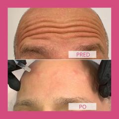 Botulotoxin - Health & Beauty Clinic MUDr. Stela Muránska