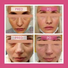 Kyselina hyaluronová - Health & Beauty Clinic MUDr. Stela Muránska