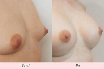 Zväčšenie prsníkov (Augmentácia)