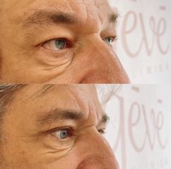 Operácia očných viečok (Blepharoplastika) - GÉVÉ Klinika