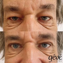 Operácia očných viečok (Blepharoplastika) - GÉVÉ Klinika