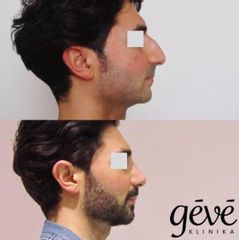 Operácia nosa (Rhinoplastika) - GÉVÉ Klinika