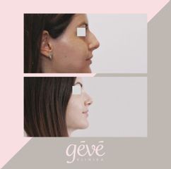 Operácia nosa (Rhinoplastika) - GÉVÉ Klinika