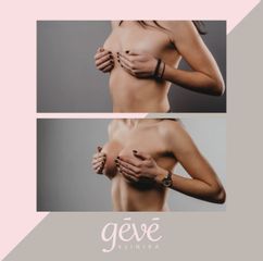 Zväčšenie prsníkov (Augmentácia) - GÉVÉ Klinika